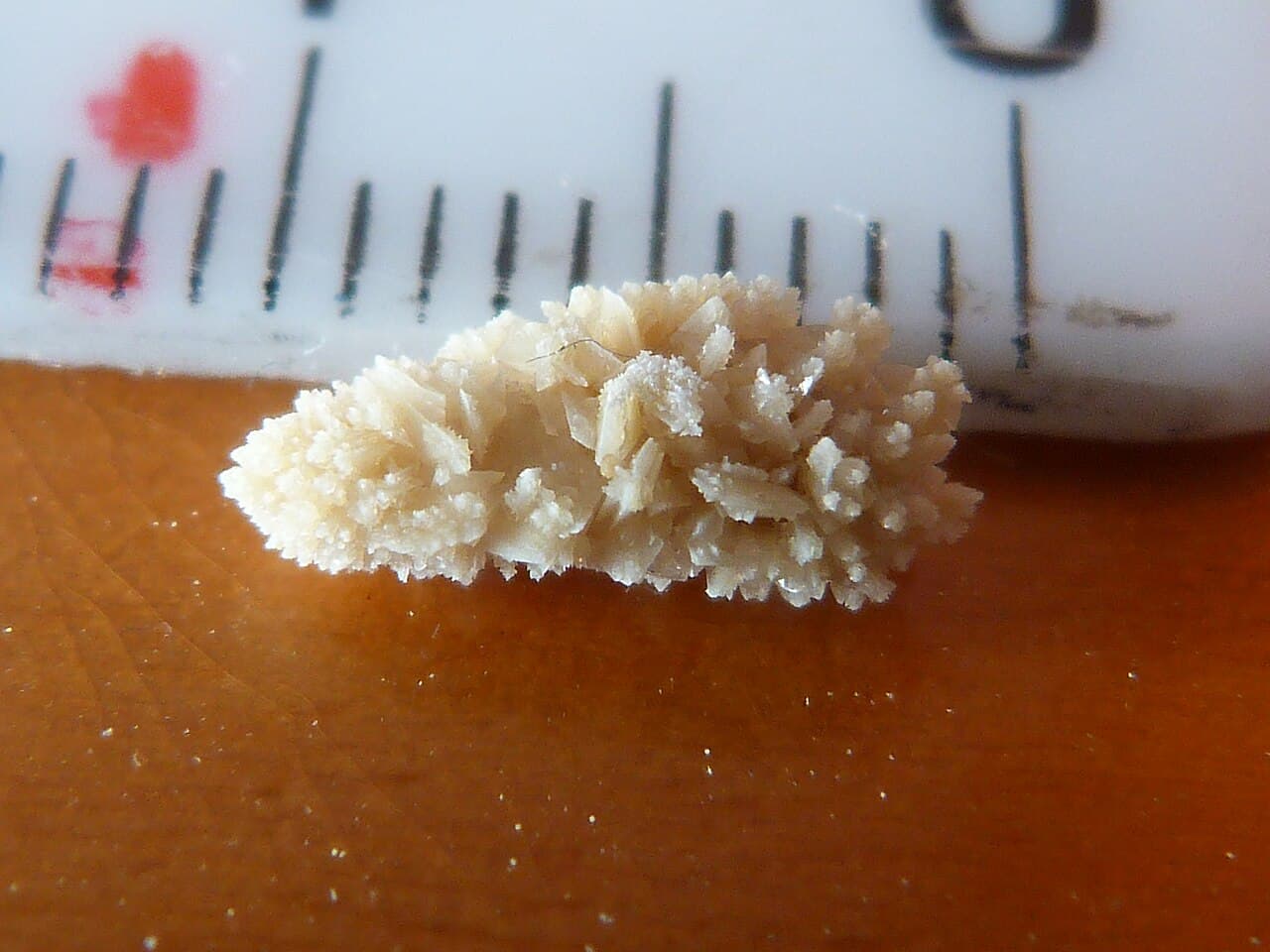 Uric acid kidney stone alkalisation